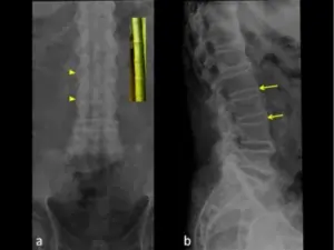 Ankylosing Spondylitis treatment in Pune